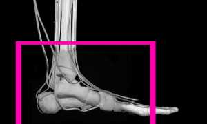 Что делать при переломе пятки и какими симптомами сопряжена такая травма