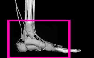 Что делать при переломе пятки и какими симптомами сопряжена такая травма