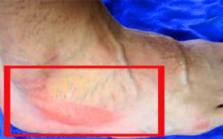 Перелом стопы