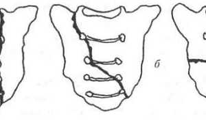 Как лечат перелом крестца и какие последствия может нести эта травма