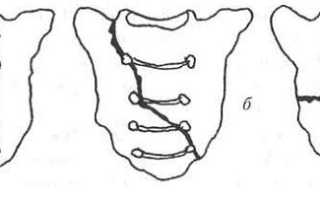 Как лечат перелом крестца и какие последствия может нести эта травма