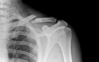 Переломы ключицы у взрослых. Причины и особенности лечения