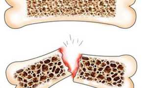 Симптомы самых распространенных переломов