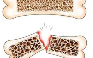 Симптомы самых распространенных переломов
