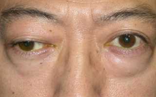 Что такое миастения и насколько она опасна для человека?