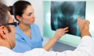 Переломы бедра: причины возникновения, основные симптомы, выбор методов лечения