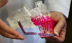 Вывих челюсти, его основные симптомы и лечение