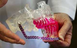 Вывих челюсти, его основные симптомы и лечение