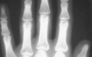 Перелом фаланги пальца: симптомы, диагностика, лечение