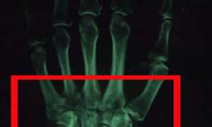 Симптомы перелома запястья, а так же его леччение и ЛФК