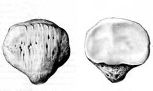 В чём опасность переломов коленной чашечки и как происходит лечение подобных травм