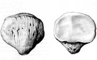В чём опасность переломов коленной чашечки и как происходит лечение подобных травм