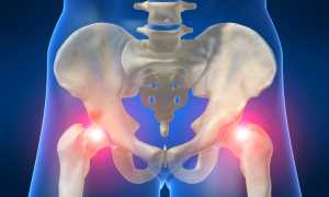 Перелом тазобедренного сустава и его лечение