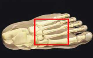 Маршевый перелом плюсневой кости