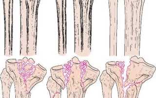 Перелом берцовой кости — разница в лечении у нас и за рубежом