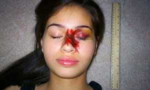 Перелом носа – симптомы, лечение и последствия