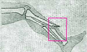 Открытые переломы. Первая помощь при открытых переломах