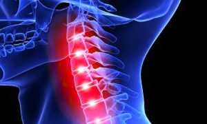 Перелом шеи и его последствия