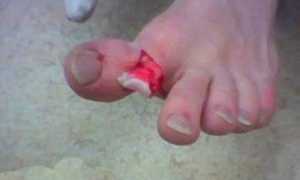 Перелом пальца на ноге — признаки и методы лечения