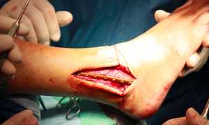 Перелом голеностопного сустава(голеностопа)