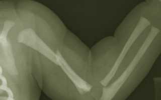 Перелом плеча и плечевой кости — лечение и реабилитация