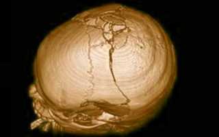 Перелом черепа — последствия и симптомы