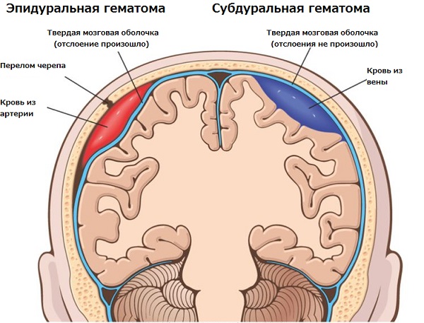 Разлиция между эпидуральной и субдуральной гематомой