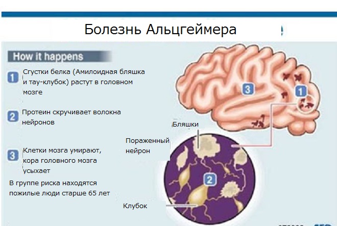 Что за болезнь