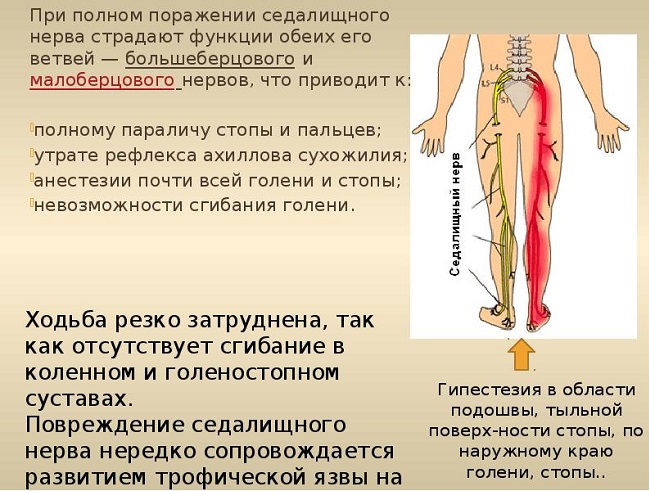 Некоторые сведения об ишиасе