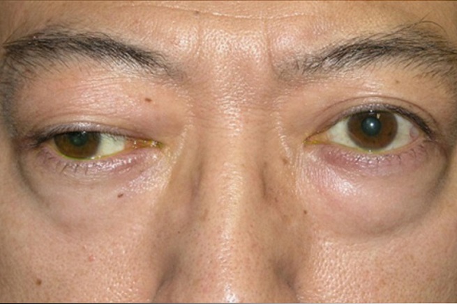 Опущение века