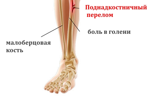 Все, что нужно знать о переломах по типу «зеленой ветки» у детей 2 2