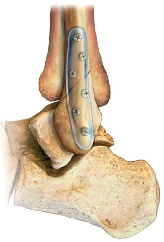 Все, что нужно знать о переломах по типу «зеленой ветки» у детей 3 3