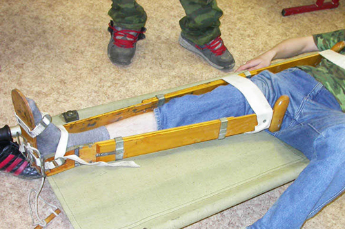 Симптомы самых распространенных переломов 7 Симптомы перелома бедра