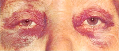 Симптомы самых распространенных переломов 10 Симптомы перелома черепа