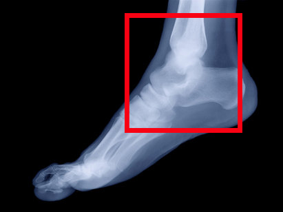 Голеностопный сустав Голеностопный сустав