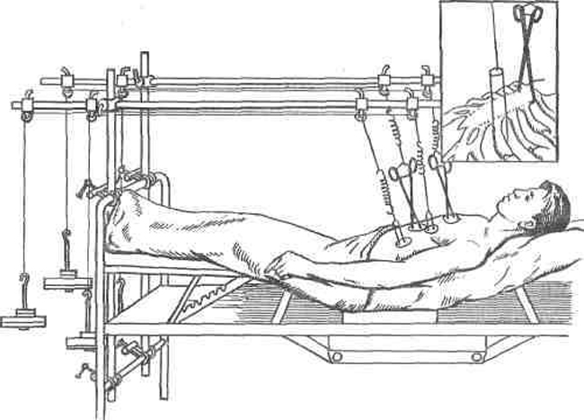 Перелом грудины и его лечение 4 Лечение перелома грудины