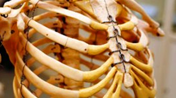 Методы лечения при переломе грудины Методы лечения при переломе грудины