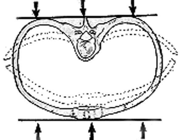 Перелом грудной клетки и его симптомы 2 симптомы перелома грудной клетки