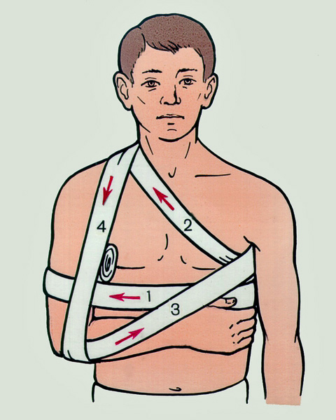 Перелом ключицы - лечение и возможные последствия 6 лечение перелома ключицы