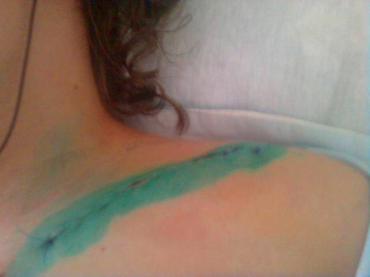 Перелом ключицы - лечение и возможные последствия 3 операция при переломе ключицы