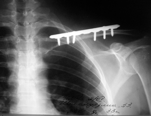 Перелом ключицы - лечение и возможные последствия 7 хирургическое лечение перелома ключицы