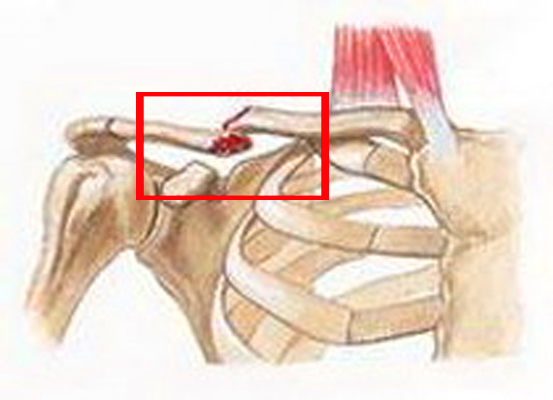 Перелом ключицы - лечение и возможные последствия 2 перелом ключицы