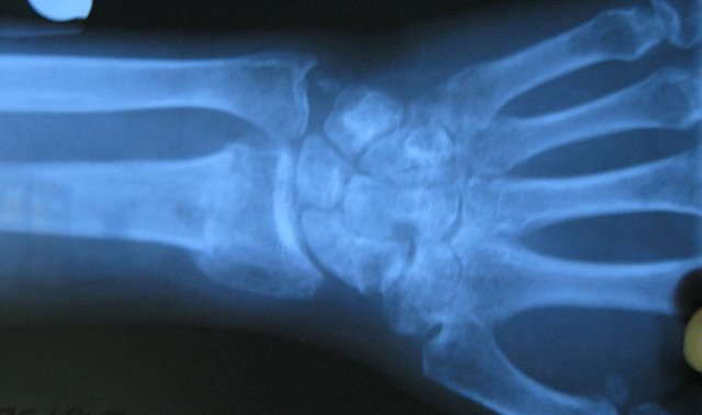 Образование костной мозоли Образование костной мозоли