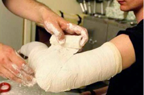 Перелом локтевого сустава 4 Лечение перелома локтевого сустава