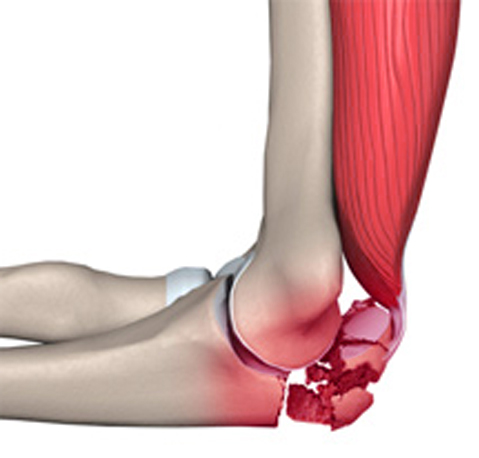 Перелом локтевого сустава 3 Симптомы перелома локтевого сустава