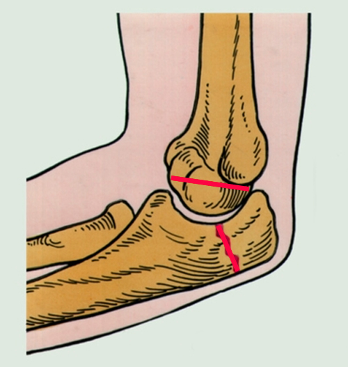 Перелом локтевого сустава 1 Перелом локтевого сустава