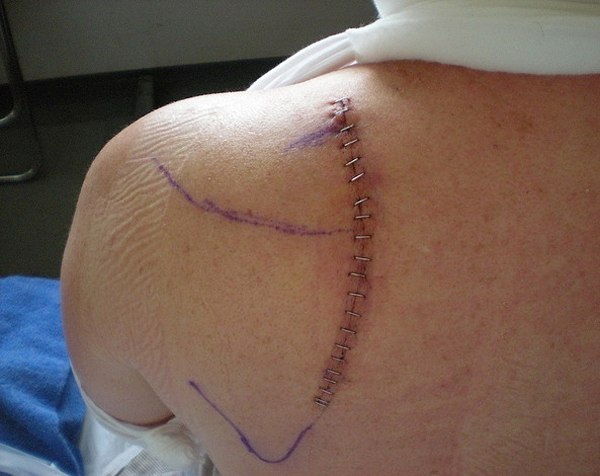 Перелом лопатки, а так же лечение и первая помощь 5 Реабилитация при переломе лопатки