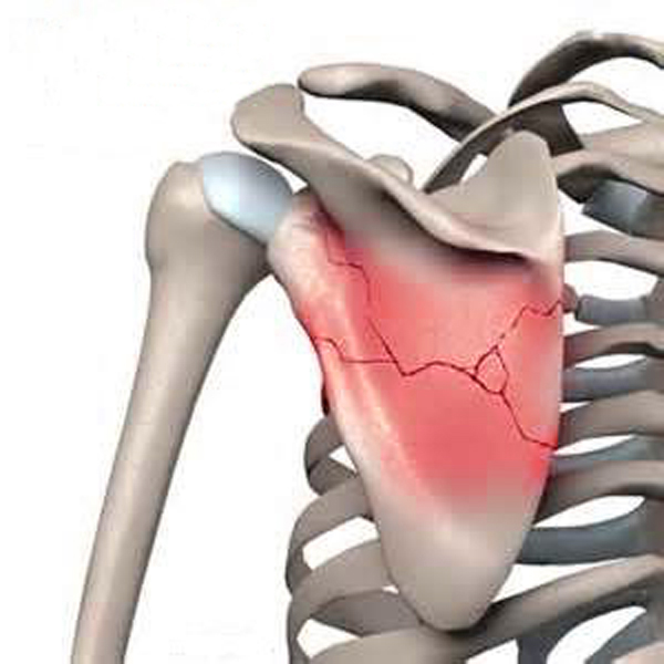 Перелом лопатки, а так же лечение и первая помощь 2 Симптомы перелома лопатки