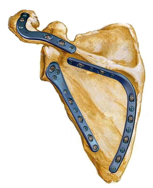 Перелом лопатки, а так же лечение и первая помощь 4 Перелом лопатки со смещением