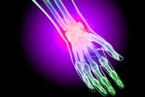 Перелом лучезапястного сустава 1 Перелом лучезапястного сустава